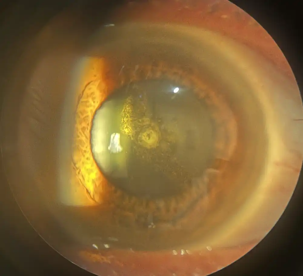 Slitlamp image of a cataract